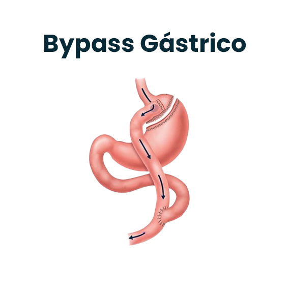 Roux-en-Y Gastric Bypass : Dr. Omar Fonseca