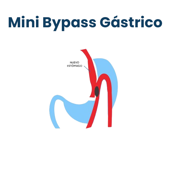 Mini bypass y Bypass de una anastomosis : Dr. Omar Fonseca